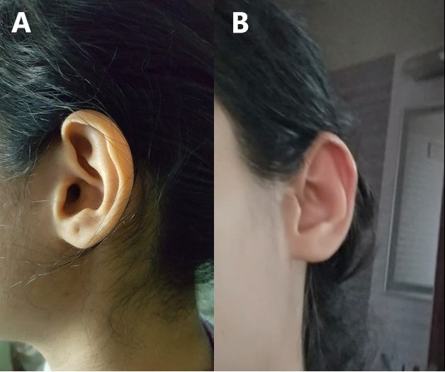 Red Ear Syndrome Preceding Multiple Sclerosis A Novel Correlation